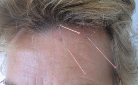 Symbolbild YNSA-Punkte und Yin-Basispunkt A