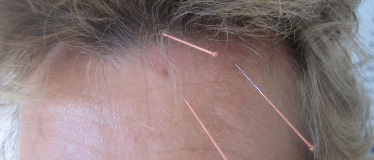 Symbolbild YNSA-Punkte und Yin-Basispunkt A