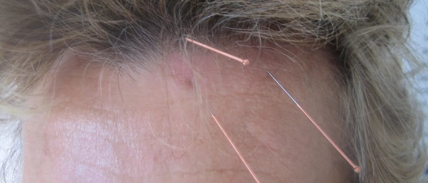 Akupunktur im Rettungsdienst (Foto: Thomas Stockert) Symbolbild YNSA-Punkte und Yin-Basispunkt A