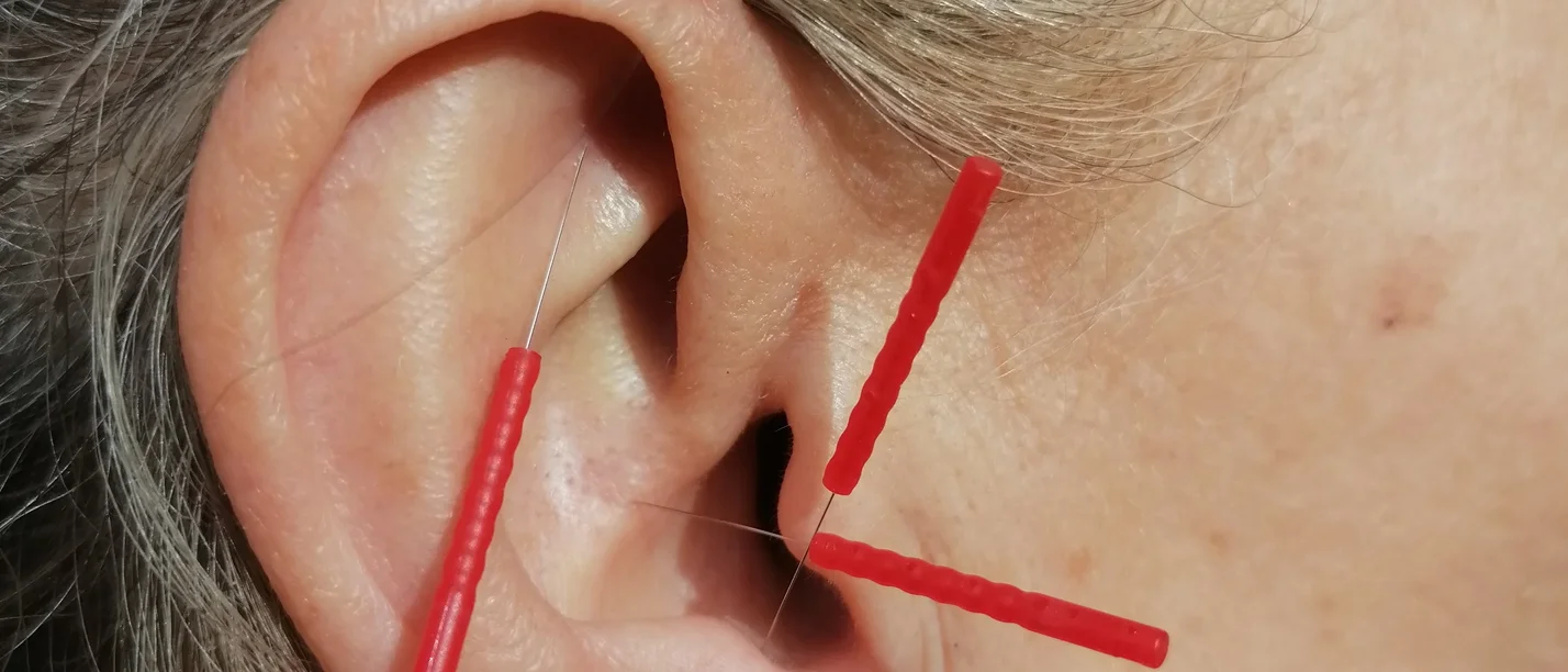 Akupunktur im Rettungsdienst (Foto: Thomas Stockert) Symbolbild Amerikanische Battlefield Akupunktur