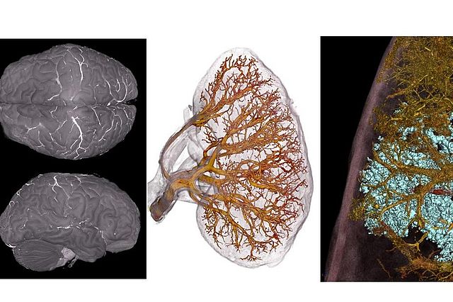 Mit der neuen HiP-CT-Röntgentechnik am europäischen Teilchenbeschleuniger ESRF im französischen Grenoble ist es möglich, ganze Organe bis in ihre kleinsten Einheiten räumlich aufzulösen (Gehirn, links; Niere, Mitte; COVID19-Lunge, rechts) (Foto: ERSF)